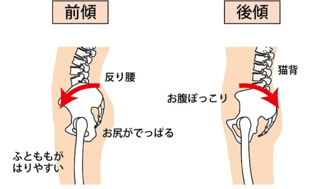 骨盤前傾、骨盤後継