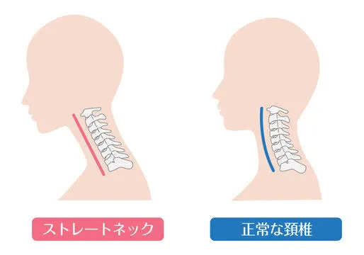 ストレートネック