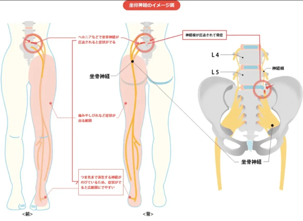 座骨神経痛